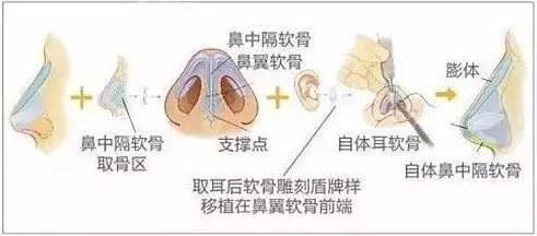 北京伊美爾醫(yī)療醫(yī)院:鼻唇溝是哪里