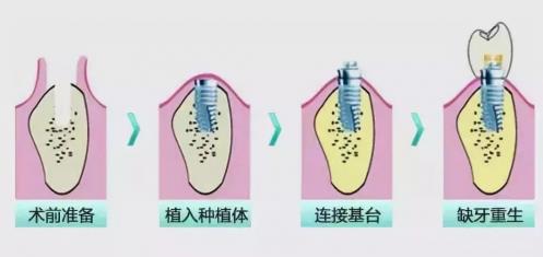岳陽種植牙哪里最好?歷時(shí)三月,終于做完種植牙!