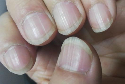 指甲上的月牙是什么?細(xì)數(shù)指甲出現(xiàn)的各種癥狀