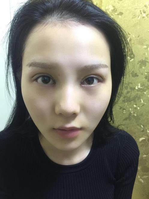 慈溪悅爾整形門診部做桃迷眼雙眼皮太好看了吧