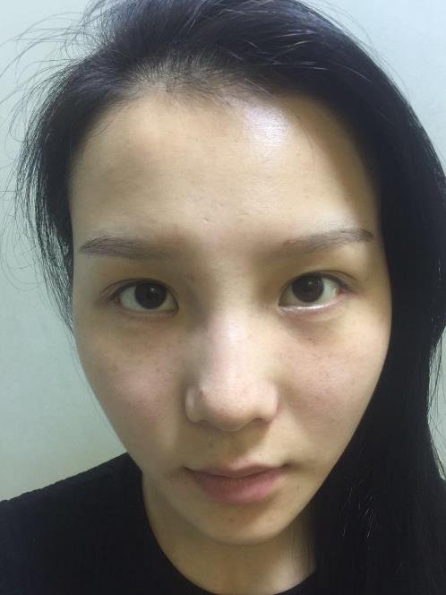 慈溪悅爾整形門診部做桃迷眼雙眼皮太好看了吧