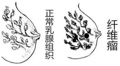 乳腺纖維瘤你怕了嗎?我的治療經(jīng)歷分享給姐妹們
