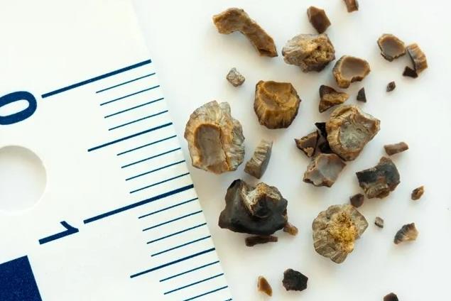 廣州治療腎結(jié)石比較好的醫(yī)院在哪里?廣州治療腎結(jié)石哪個(gè)醫(yī)生好?