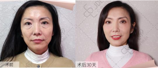 京典麗園不開刀去眼袋多少錢?正常情況下應該是多少?