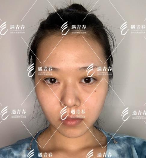 遇青春不開(kāi)刀去眼袋,對(duì)癥“下藥”告別眼袋困擾!