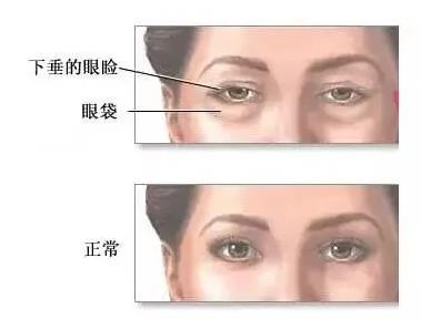 遇青春不開(kāi)刀去眼袋,對(duì)癥“下藥”告別眼袋困擾!