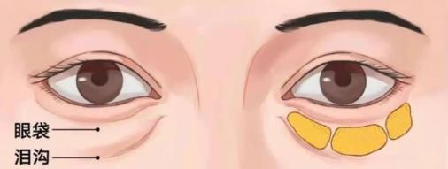 遇青春不開(kāi)刀去眼袋,對(duì)癥“下藥”告別眼袋困擾!
