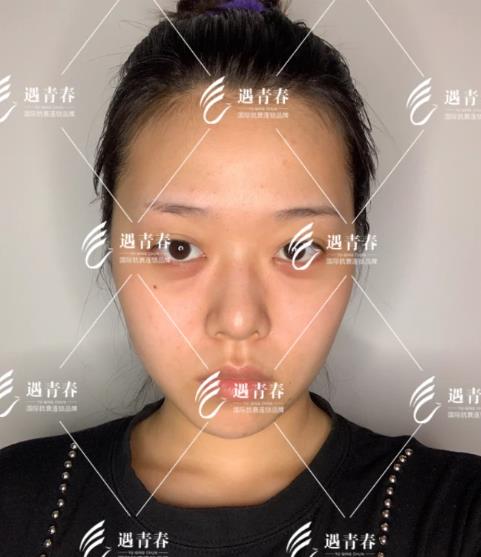 遇青春不開(kāi)刀去眼袋,對(duì)癥“下藥”告別眼袋困擾!