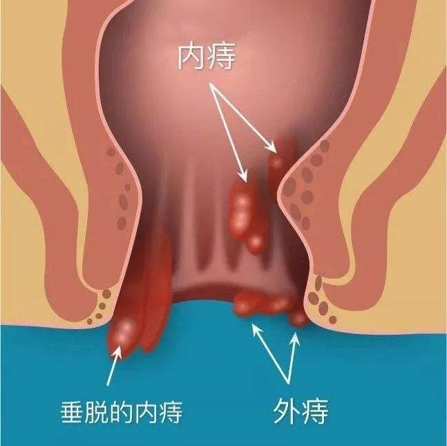 痔瘡長什么樣子在哪個位置圖片 內(nèi)痔外痔混合痔肉球脫出癥狀對照圖片