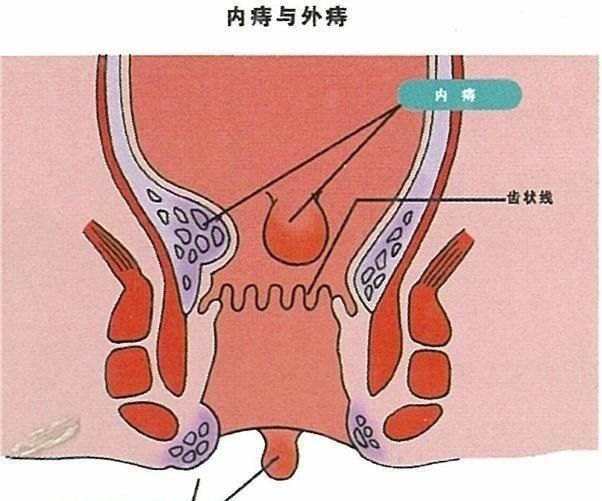 痔瘡長什么樣子在哪個位置圖片 內(nèi)痔外痔混合痔肉球脫出癥狀對照圖片