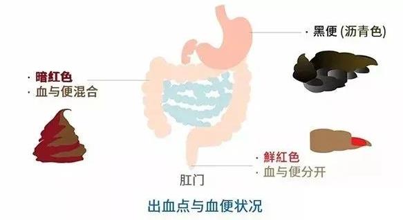 貴州東大肛腸醫(yī)院:大便帶血怎么回事?需要做什么檢查?