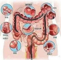 貴州東大肛腸醫(yī)院:大便帶血怎么回事?需要做什么檢查?