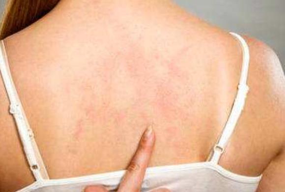 背部痤瘡很容易被忽視 推薦2種預(yù)防后背長痘痘的方法