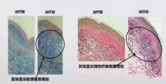 北京伊美爾健翔醫(yī)院:激光祛斑效果前后對比