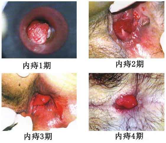 女性痔瘡真人實拍圖片 網(wǎng)上曝光的7個小偏方有效治痔瘡 女性痔瘡真人實拍圖片:網(wǎng)上曝光的7個小偏方有效治痔瘡