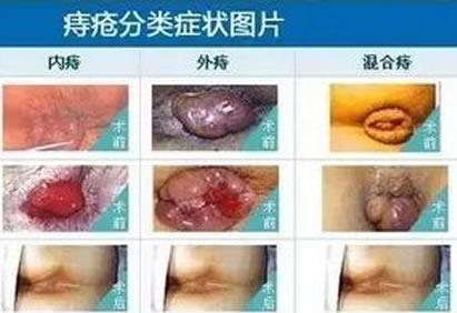女性痔瘡真人實拍圖片 網(wǎng)上曝光的7個小偏方有效治痔瘡