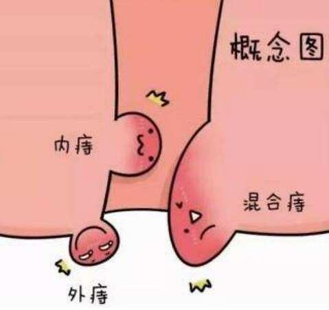 女性痔瘡真人實拍圖片 網(wǎng)上曝光的7個小偏方有效治痔瘡