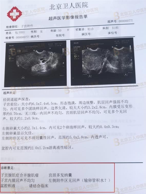 子宮腺肌癥能保住子宮嗎?50歲包大姐終于打贏這場長達20年的“子宮保衛(wèi)戰(zhàn)”!