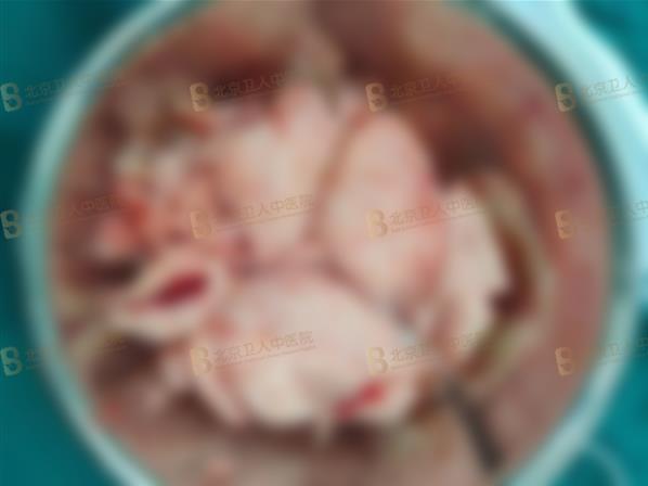 子宮腺肌癥能保住子宮嗎?50歲包大姐終于打贏這場長達20年的“子宮保衛(wèi)戰(zhàn)”!