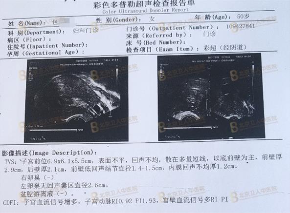 子宮腺肌癥能保住子宮嗎?50歲包大姐終于打贏這場長達20年的“子宮保衛(wèi)戰(zhàn)”!