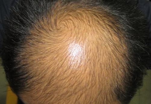 所謂“養(yǎng)腎補(bǔ)腎”防脫發(fā)，風(fēng)牛馬不相及