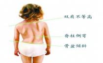 如何盡早發(fā)現(xiàn)孩子脊柱側(cè)彎？
