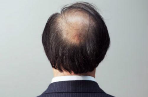 想要遠離脫發(fā) 男人要做持久戰(zhàn)
