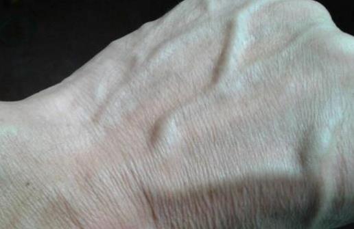 手上青筋說明身體有濕氣 不同部位青筋顯示不同問題