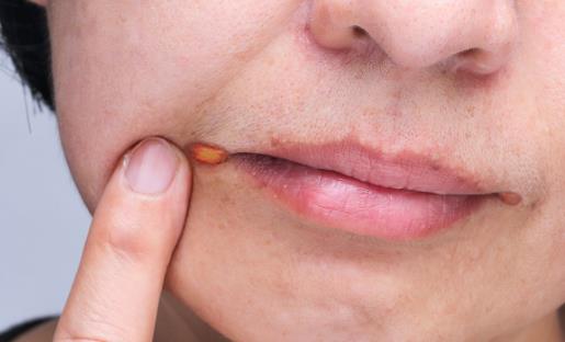 精神壓力大易導(dǎo)致口腔潰瘍 中醫(yī)偏方可治療口腔潰瘍