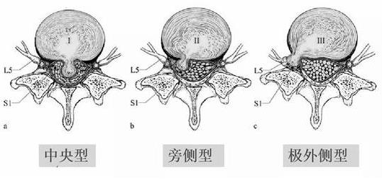 患上腰椎病，一定不能拖！內(nèi)鏡微創(chuàng)手術(shù)，一步治好它！