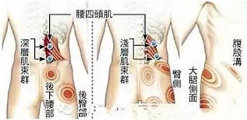 湛江崇愛康復(fù)醫(yī)院科普如何防治肌筋膜炎 以真誠來服務(wù)患者