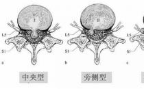 患上腰椎病，一定不能拖！內(nèi)鏡微創(chuàng)手術(shù)，一步治好它！