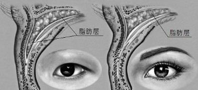 內(nèi)眥贅皮怎么做效果好——北京彤美整形醫(yī)院劉風卓