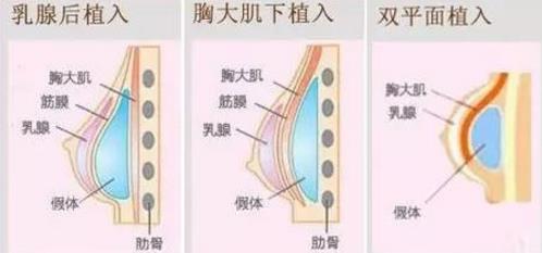 北京韓嘯醫(yī)生：為什么假體隆胸手術(shù)之后胸部疼痛