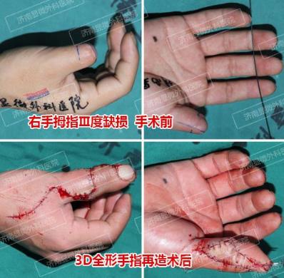 濟(jì)南顯微外科醫(yī)院 黃威手指再造怎么樣 有真實的手術(shù)案例嗎