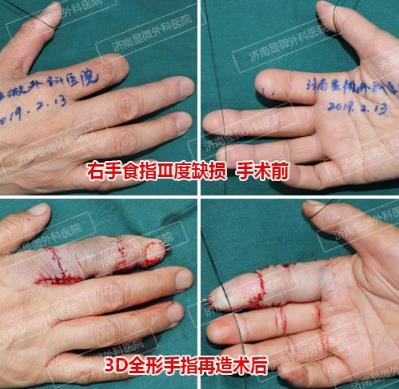濟(jì)南顯微外科醫(yī)院 黃威手指再造怎么樣 有真實的手術(shù)案例嗎
