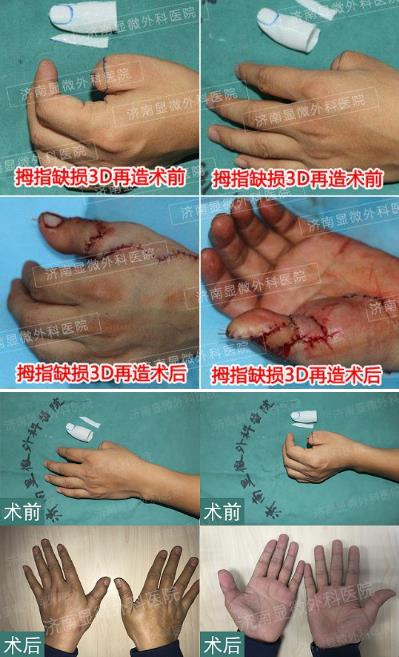 濟(jì)南顯微外科醫(yī)院 黃威手指再造怎么樣 有真實的手術(shù)案例嗎