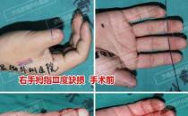 濟南顯微外科醫(yī)院 黃威手指再造怎么樣 有真實的手術案例嗎