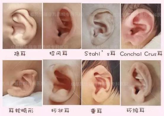 新生兒耳廓畸形能矯正嗎？看成都民生耳鼻喉醫(yī)院如何支招