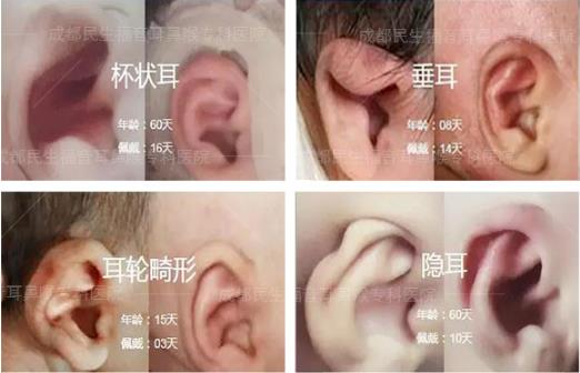 新生兒耳廓畸形能矯正嗎？看成都民生耳鼻喉醫(yī)院如何支招