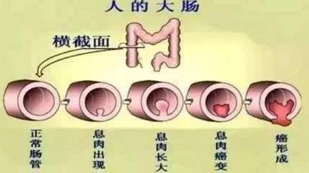 武漢漢西博仕肛腸醫(yī)院強(qiáng)調(diào)：痔瘡原本很好治 久拖治療難度加大