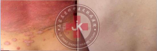許光生：多年兒童牛皮癬終于治好，兒童牛皮癬怎么治