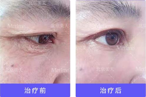 熱瑪吉抗衰(Thermage)官方認(rèn)證中國指定操作醫(yī)生—北京美天張潘院長