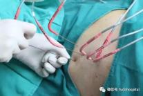 廣州復(fù)大腫瘤醫(yī)院牛立志：晚期肺癌引起失眠如何治療