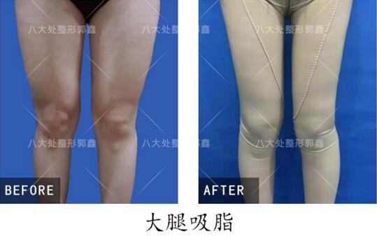 八大處整形郭鑫教授解答：大腿吸脂手術(shù)瘦腿明顯嗎