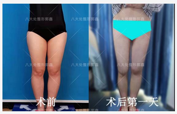 八大處整形郭鑫教授解答：大腿吸脂手術(shù)瘦腿明顯嗎