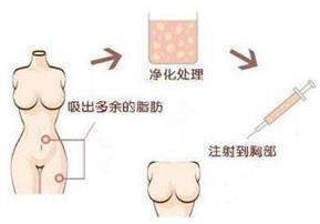 煤醫(yī)整形：自體脂肪豐胸的四大優(yōu)勢
