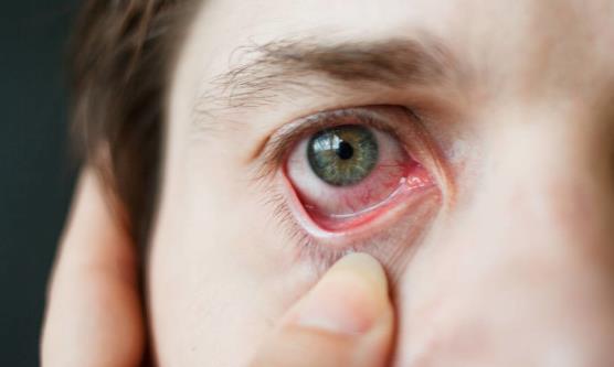 紅血絲青睞眼部和臉上 要怎么有效擺脫？