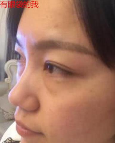 衛(wèi)婭日記：我一直都以為眼袋對我的影響只是美觀，直到我了解了以后……