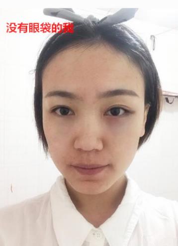 衛(wèi)婭日記：我一直都以為眼袋對我的影響只是美觀，直到我了解了以后……